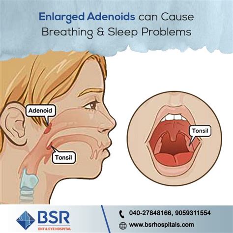 Enlarged on infected adenoids in children can cause irregular breathing at night and distrub ...