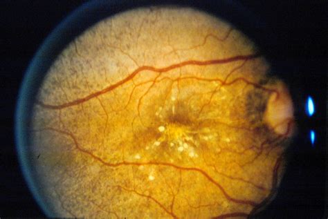 Fungal eye infections - Life Worldwide