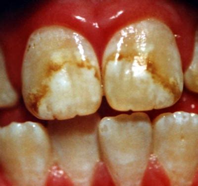 Dental fluorosis – Clinical features and treatment