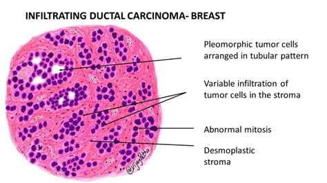 Invasive Ductal Carcinoma Histology