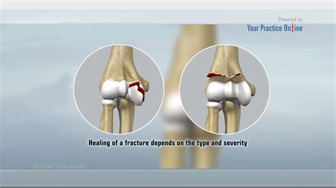 Elbow Fracture Video | Medical Video Library