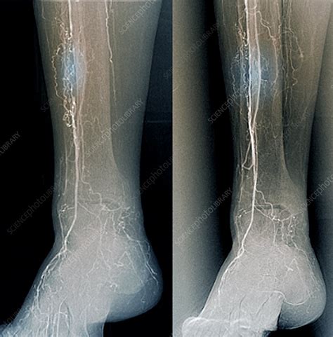 Treatment for blocked leg arteries, X-ray - Stock Image C033/7344 ...