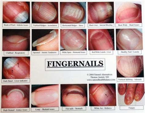 1. Fingernail with disorder | Health signs, Nail health signs ...