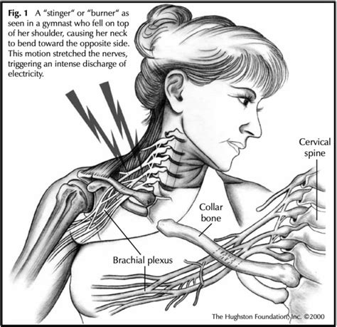 Stingers and Burners - Hughston Clinic