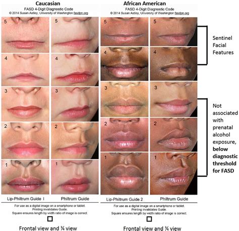 Philtrum of lip, causes of smooth philtrum, long or short philtrum