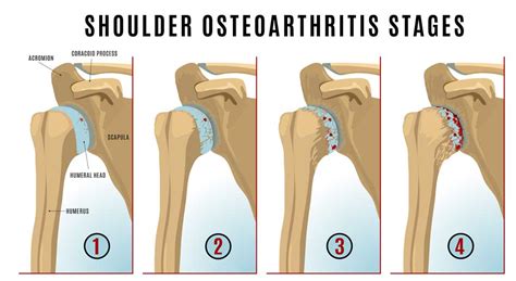 Glenohumeral Joint Degeneration