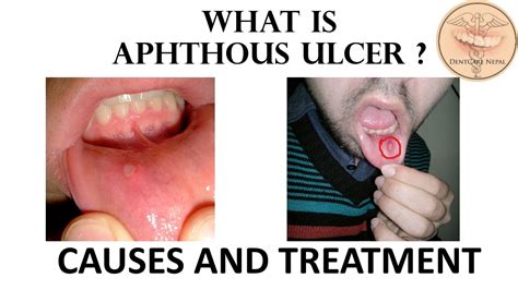 Aphthous Ulcer - Causes and Treatment - Apthous Ulcer - YouTube