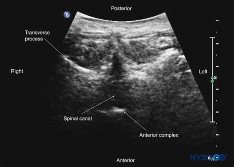 Spinal Sonography and Applications of Ultrasound for Central Neuraxial Blocks - NYSORA