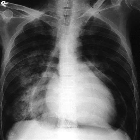 Pneumopericardium in AIDS | Heart Asia