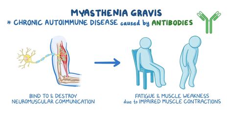 Myasthenia Gravis Symptoms and Treatment, Dr. Tarun Mathur