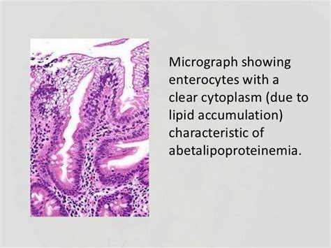 Abetalipoproteinemia