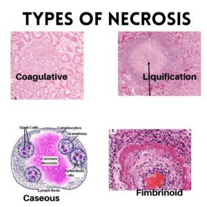 Necrosis: Pathology, Types & Causes- Healthpathy