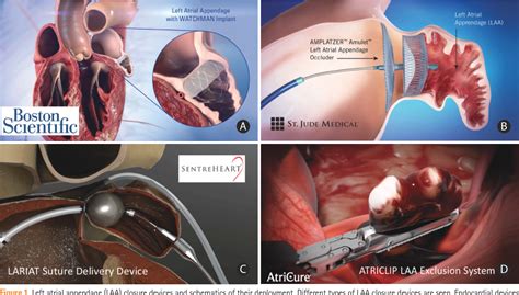 Figure 1 from Percutaneous Left Atrial Appendage Occlusion for the ...