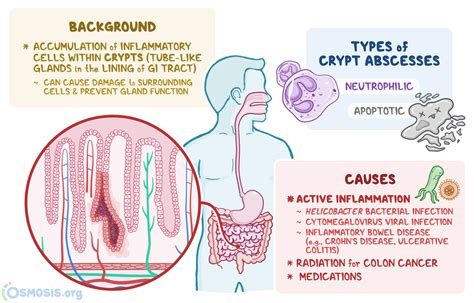 Crypt Abscess: What Is It, Causes, Diagnosis, and More | Osmosis