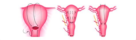 B-Lynch, Cho and Hayman uterine compression sutures | Download Scientific Diagram