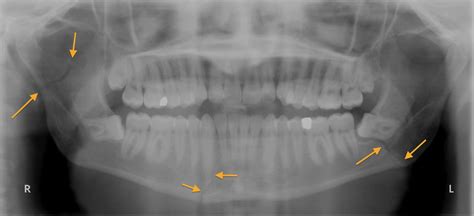 Mandibular fractures - OPG - Radiology at St. Vincent's University Hospital