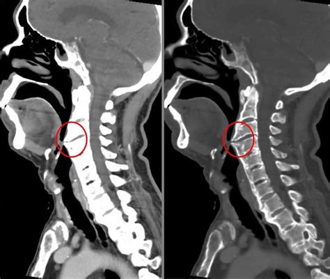 Diffuse idiopathic skeletal hyperostosis, hyperostosis frontalis ...