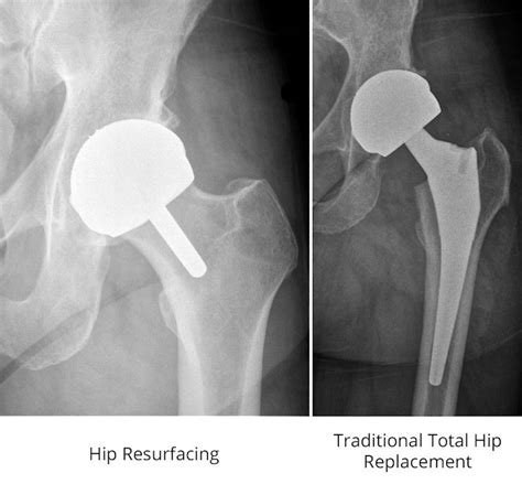 Hip to It: What Runners Should Know About Hip Replacement Options – iRunFar