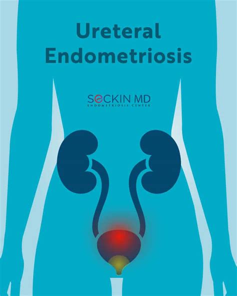 Ureteral Endometriosis - Seckin Endometriosis Center