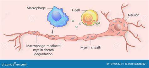 Multiple Sclerosis and Myelin Sheath Breakdown Stock Illustration - Illustration of development ...