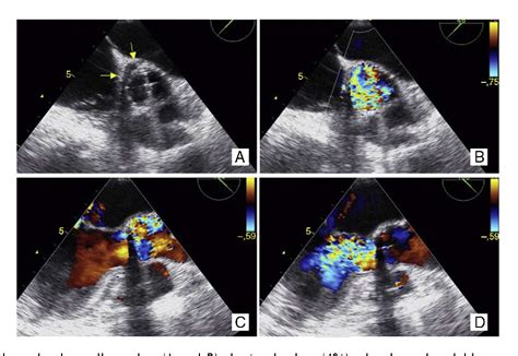 Figure 4 from A rare cause of subendocardial ischemia. | Semantic Scholar