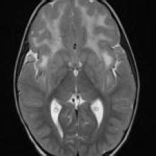 Alexander Disease Type I | American Journal of Neuroradiology