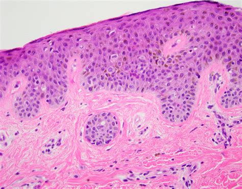 Nevus Comedonicus Histology