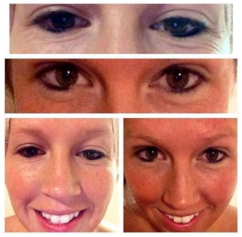 Botox Under Eyes Photos (9) » Facial Injections: Info, Prices, Photos ...