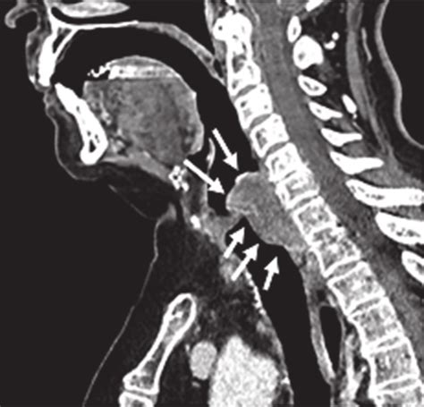 Contrast-enhanced CT neck scan demonstrating malignancy of the... | Download Scientific Diagram