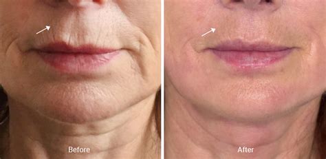 Lip Wrinkles: Best Treatments and Preventative Measures