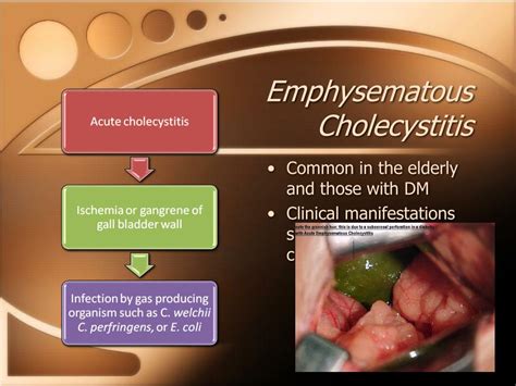 PPT - Acute Cholecystitis PowerPoint Presentation, free download - ID:2055111