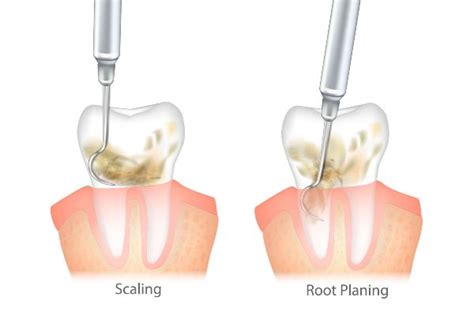 Dental Scaling & Root Planing in South Edmonton, AB