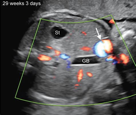 Fetal Umbilical Vein Ultrasound