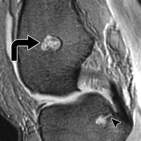 Incidental Enchondromas of the Knee | AJR