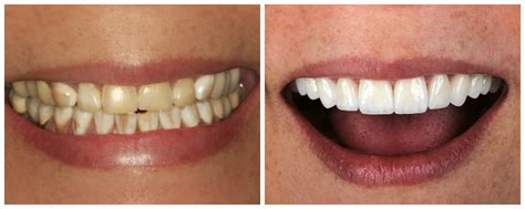 Full Upper-Mouth Dental Restoration Using e.max and Zirconia