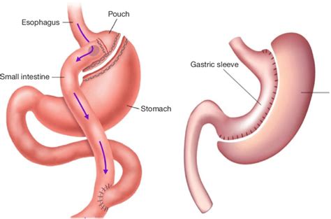 Picture of Roux-en-Y gastric bypass and sleeve gastrectomy. | Download Scientific Diagram