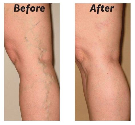 Varicose veins are twisted, enlarged veins near the surface of the skin ...