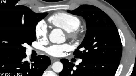 Left Atrium Anatomy on Axial Cardiac CT - YouTube