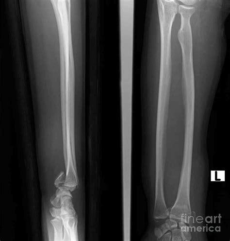 Smith Fracture Photograph by Rajaaisya/science Photo Library - Fine Art ...