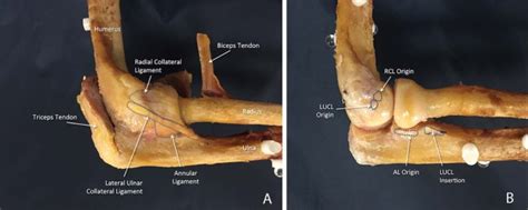 The lateral collateral ligament complex of the elbow: quantitative anatomic analysis of the ...