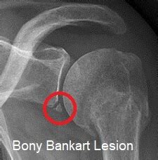 Bankart Lesion: Causes, Symptoms & Treatment