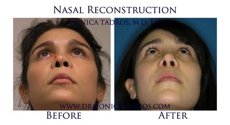 Nasal Reconstruction in NJ & NYC | Nose Reconstruction Surgery