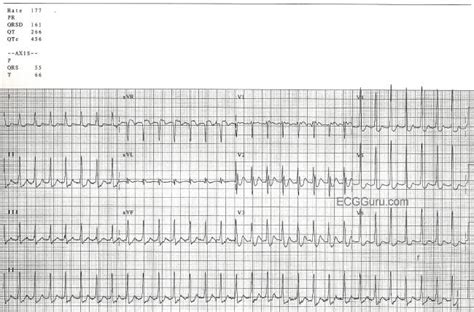 Paroxysmal Supraventricular Tachycardia | ECG Guru - Instructor Resources