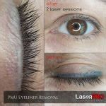 Eyeliner Tattoo Removal - How to Remove Permanent Eyeliner?