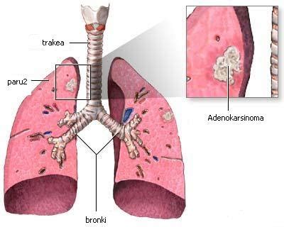 Bronchogenic Carcinoma | Procedure, Treatment and Therapy