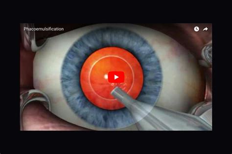 Laser Cataract Surgery in Honolulu — Dr Rupa