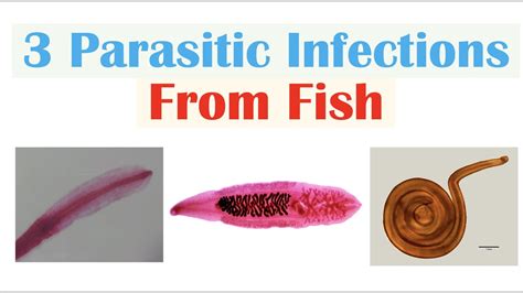 3 Parasitic Infections From Fish (Diphyllobothriasis, Clonorchiasis, Anisakiasis) - YouTube