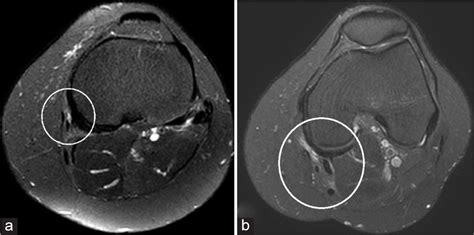 Posteromedial knee friction syndrome: Diagnosis by magnetic resonance imaging - Indian Journal ...