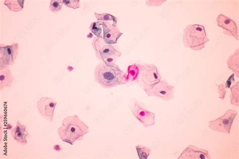 Abnormal squamous epithelial cells view in microscopy.HPV criteria for pap smear slide cytology ...