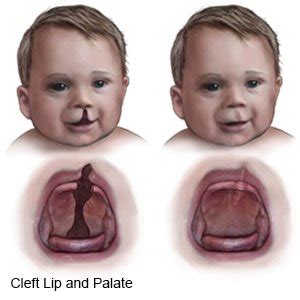 Cleft Lip Surgery Before And After